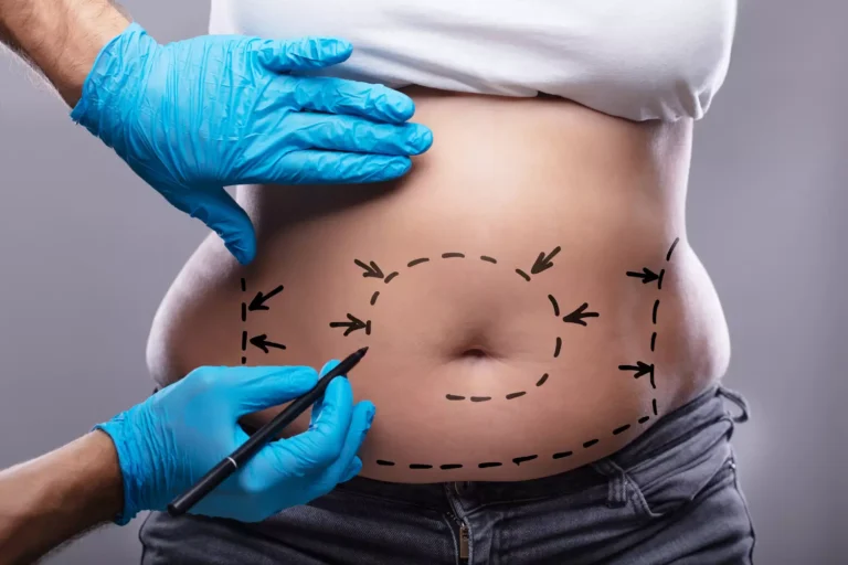 Comment se préparer mentalement et physiquement avant une chirurgie bariatrique ?