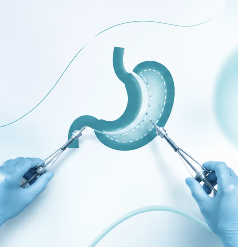 Illustration de la chirurgie bariatrique : estomac et instruments chirurgicaux