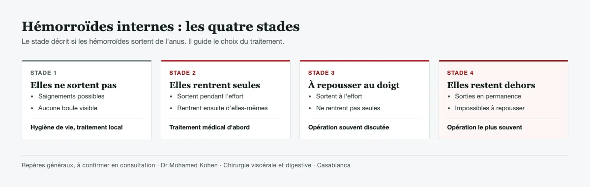 Les quatre stades des hémorroïdes internes : stade 1 sans sortie, stade 2 qui rentre seule, stade 3 à repousser avec le doigt, stade 4 qui reste dehors en permanence